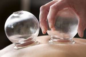 Cupping on skin for better circulation and healing - Janet Lee