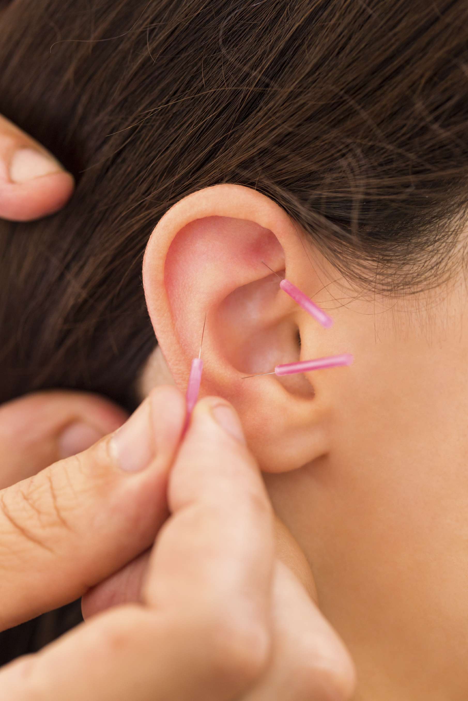 Acupuncture to different parts of the ear for pain management - Janet Lee