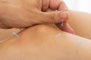 Acupuncture in the distal patella for pain management